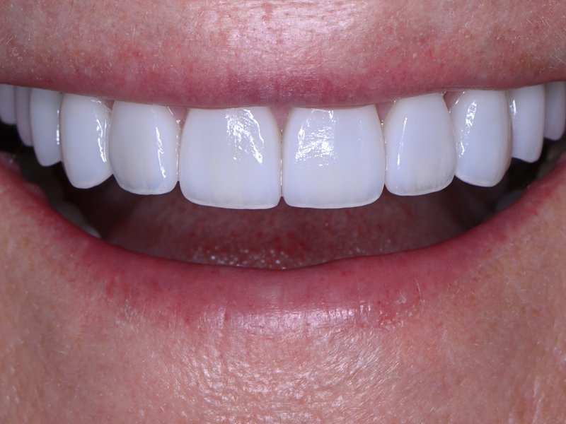 Joy's smile after treatment