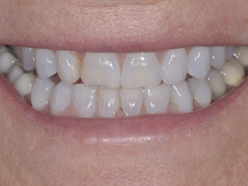 Joy's smile before treatment