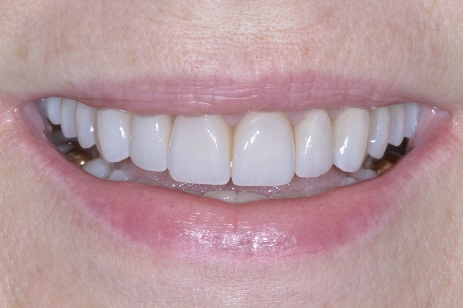 Regina's smile after treatment
