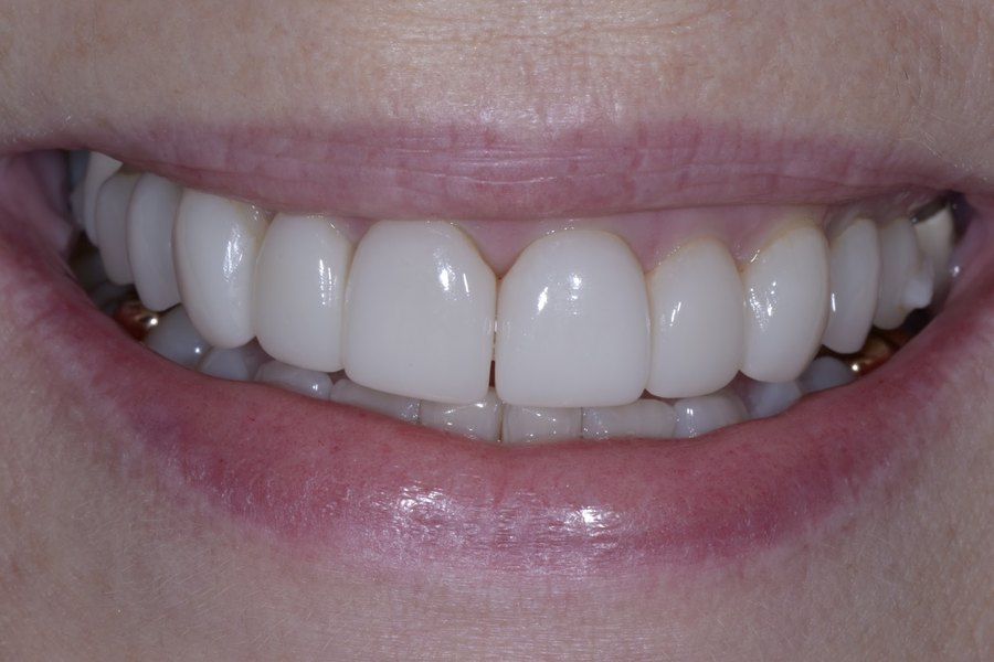 Regina's smile before treatment