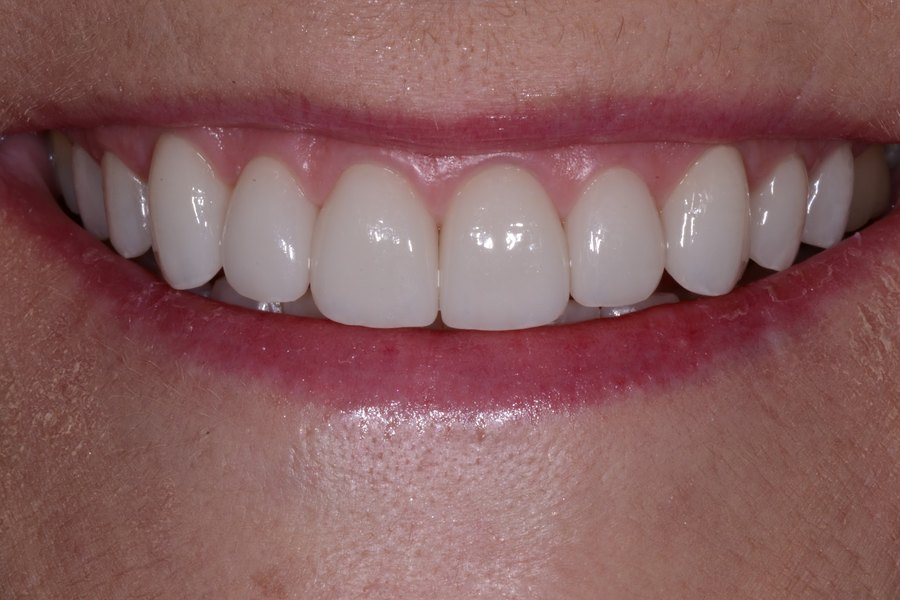 Tina's smile after treatment